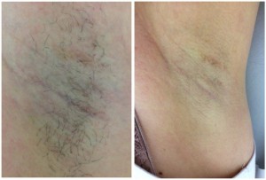before and after ipl hair doncaster 1