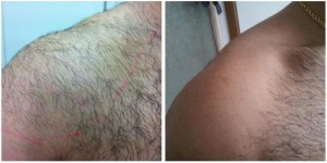 before and after ipl hair removal doncaster