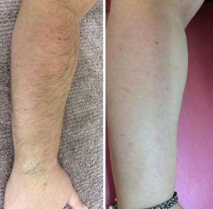 before and after laser hair doncaster