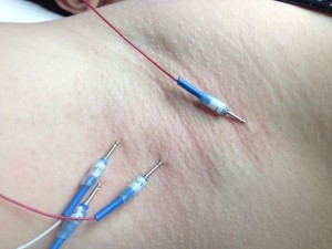 Body Machine Electrolysis Australia