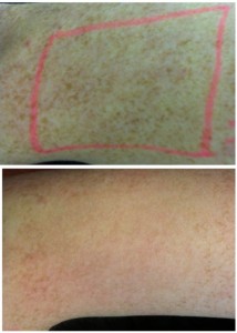 pigmentation before and after
