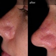 Red Vein Removal