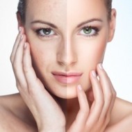 Laser IPL Skin Rejuvenation